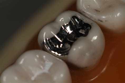 AMALGAM .